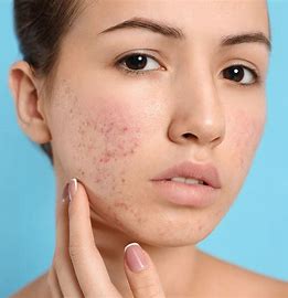 DERMATOLOGY, EZCEMA AND SKIN PROBLEM